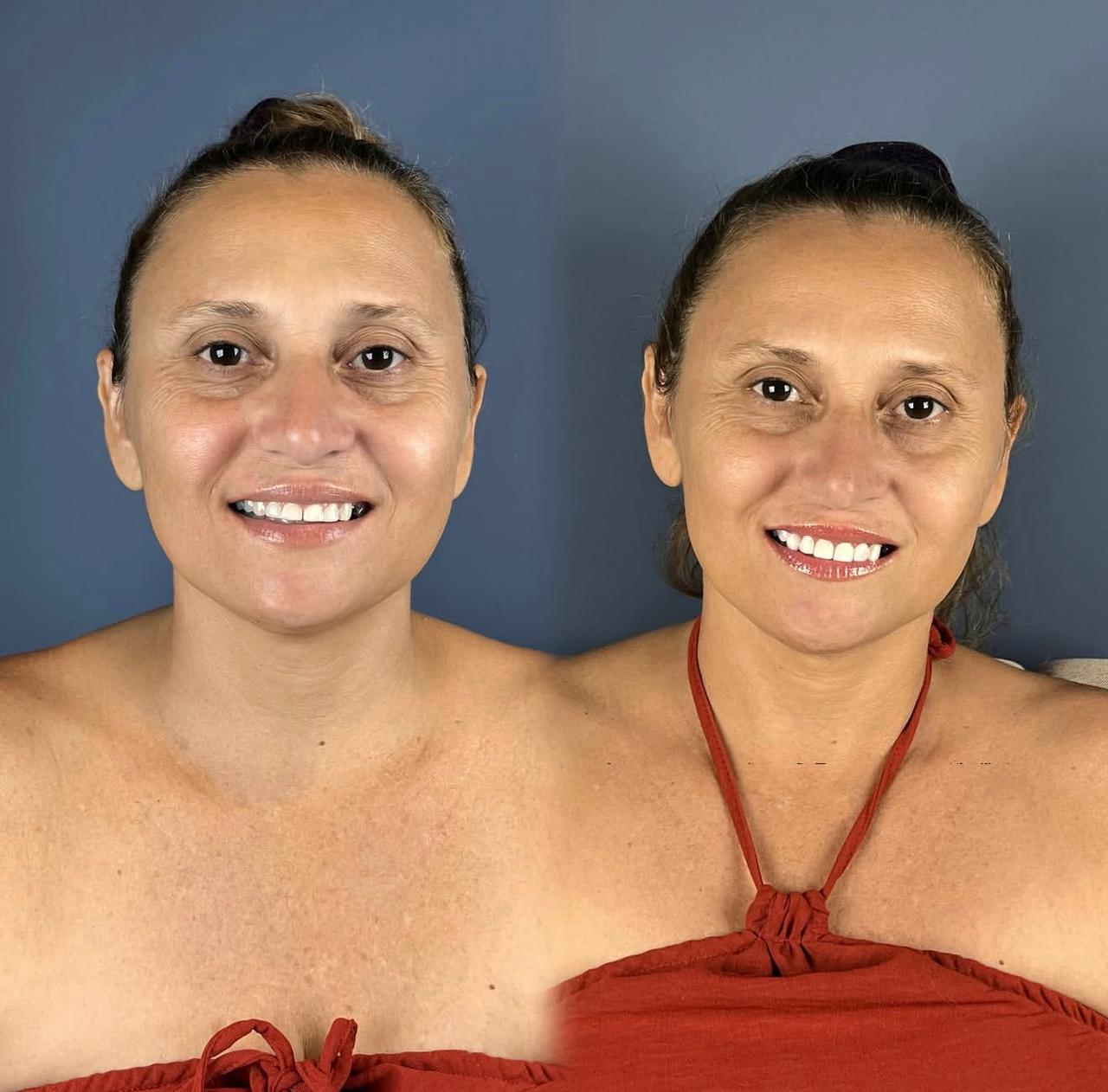 Resultado real: sorriso antes e depois do tratamento com o Dr. Rodrigo Dantas